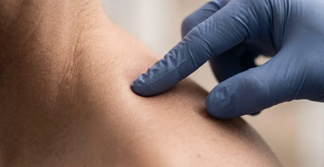 Cartographie de la douleur référée musculaire montrant les zones de projection des trigger points